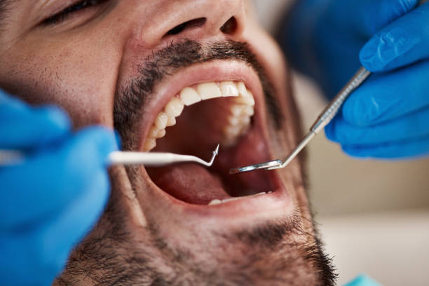 Dental Bonding in Seatac, WA